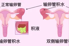 输卵管积水是备孕“拦路虎”？这样内外兼治，轻松扫清自怀障碍！图片