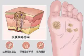 脚底长茧子是HPV病毒？医生：别不拿茧子当回事，三种情况要注意图片