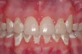牙釉质脱矿了，该如何挽救?图片