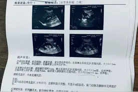 2023年对于输尿管结石如何排石我有了一些体会图片