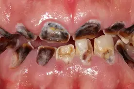 牙齿一颗接一颗烂到停不下来，怎么办？图片
