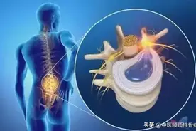 腰突症更可怕的症状还不是“疼痛”！图片