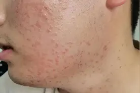 皮肤上这种小颗粒不是粉刺，是HPV感染！几乎50%的人都长过→图片