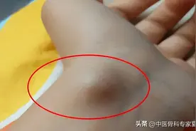 正确认识腱鞘炎，以及治疗方法，告别“妈妈手”“鼓包手”图片