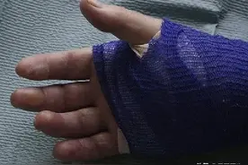 糖尿病人皮肤出现4个表现，是血糖失控的信号！别等出现了才后悔~图片