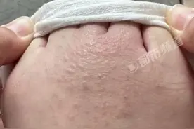 女子商场试鞋脚部真菌感染图片