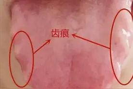 舌有齿痕，十有八九长结节，抓一把陈皮，熬成一碗“排湿汤”图片