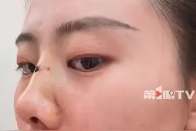 女子鼻骨骨折喜提高鼻梁，效果堪比医美，评论区纷纷求教笑死了！图片