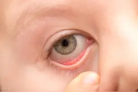 异物入眼的正确处理方法图片