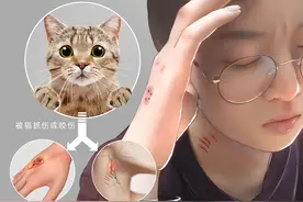 20岁小伙反复高烧40℃、几近失明！只因接触了这种动物……图片