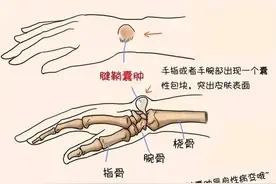 腱鞘囊肿，不花钱又简单的治疗方法：图片