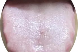 湿气重，舌头表现明显，藏不住，身上至少有这5种病，看舌选方！图片