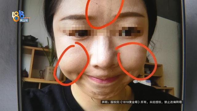 注射的胶原蛋白能不能溶掉 2026年注射胶原蛋白能溶解吗
