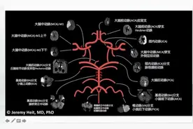 脑血管供血分布图及定位图片