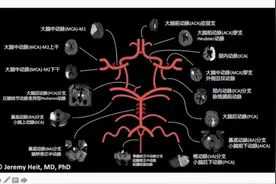 脑血管供血分布图及定位图片