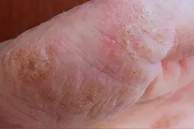 汗疱疹又痒又疼反复难愈?多半是体内有毒!5个办法有效缓解图片