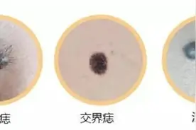 了解皮肤色素痣：成因、种类和治疗方法图片
