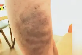 家长花了43000元 5岁男孩学平衡车被打得伤痕累累 “教练用柳条抽身” 律师：体罚不是教育惩戒！图片