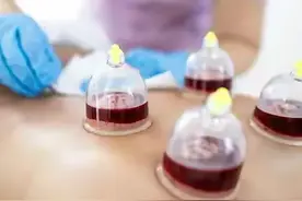 阿姨坚持拔血罐查出严重贫血图片