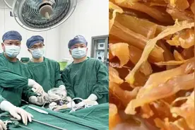 女子连吃1周笋干小肠被切25厘米：引发肠梗阻，疼到满地打滚图片