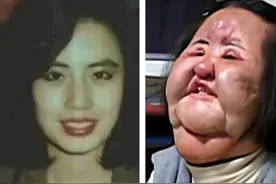 韩国“镜子公主”整容上瘾，自行注射大豆油，竟把脸整成电风扇图片