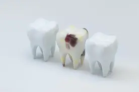 龋齿为什么是黑色？龋齿为什么容易发生在大牙上？图片