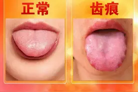 舌边长期出现齿痕，并不全是湿气重，还可能是这3个原因！图片