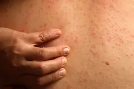 为何会突发荨麻疹？医生直言：家里的这几种东西，是发病的根源！图片