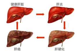 肝病多是“拖”出来的！晨起3个表现是肝在求救，别以为只是没睡好，熬成癌才后知后觉图片