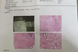 HPV高危感染，低级别鳞状上皮内病变，好好治疗，没什么大不了的图片
