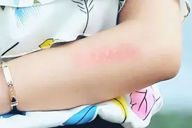 4个中成药止痒祛湿，用于过敏、皮肤瘙痒、荨麻疹、湿疹都好用！图片