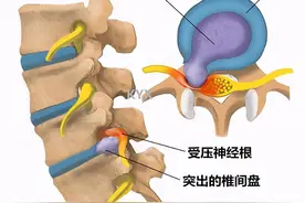 腰椎间盘突出压迫坐骨神经痛，怎么办？图片