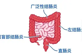 老中医一剂良方，终结 5 年溃疡性结肠炎纠缠！图片