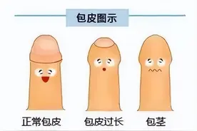 暑期迎来小儿“割包皮热”！关于割包皮你需要知道这几点图片