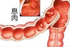 乌梅配红藤、金荞麦，轻松守护肠道健康！图片