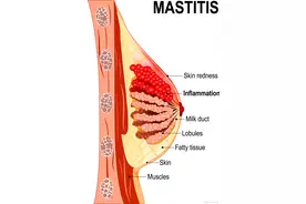 乳腺炎：了解病因、症状和治疗方法的综述图片