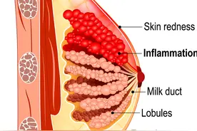 乳腺炎：了解病因、症状和治疗方法的综述图片