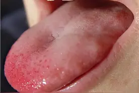 舌尖疼心火，舌中疼胃火，舌边疼肝火！3个中成药，清泻三脏之火图片