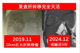 3位肝转移患者的治疗：如何迈过5年这个坎图片