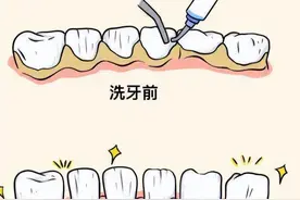 洗牙会伤牙吗？三甲医院医生说…图片
