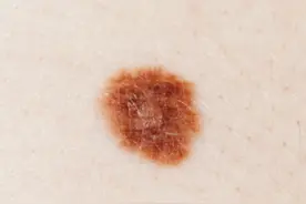 下颌出现不痛不痒的结节，竟是黑色素瘤转移灶？身上的黑痣最怕这件事！图片