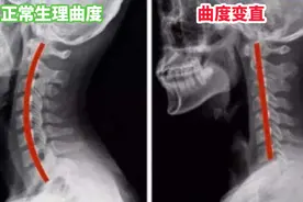 颈椎曲度变直到底是怎么回事？您也有这样的困扰吗？图片