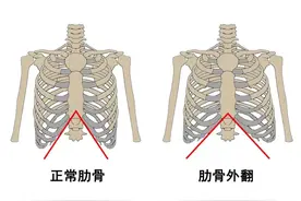 那个「抬头挺胸」的人，可能早就肋骨外翻了图片