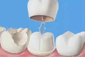 根管后戴牙冠是医生忽悠你吗？图片
