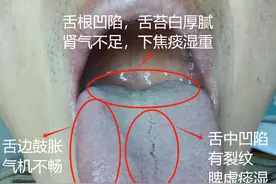 彭医生粉丝案例:容易上火，男科差，大小便不正常，晚上睡不着！图片