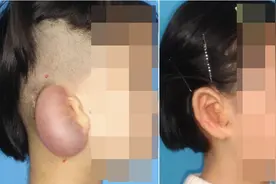 拯救“消失”的耳朵图片