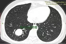 边界光整的实性肺结节不都是良性的，还要当心这类恶性肿瘤！图片