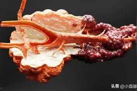 短短一年糖尿病变胰腺癌？医生：糖尿病警惕这3点，患癌率或增大图片