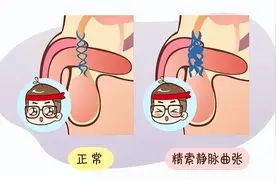 中国男性健康日|精索静脉曲张，你了解吗？图片