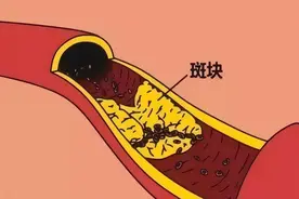 颈动脉斑块，做什么检查能发现？提醒：1个检查，有效且便宜！图片